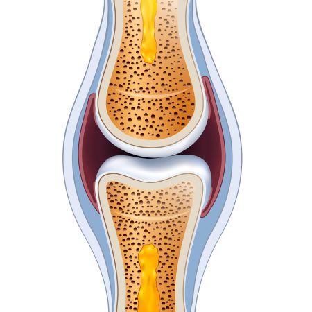 painful joints
